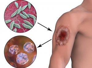 ליישמניאזיס של העור - cutaneous leishmaniasis