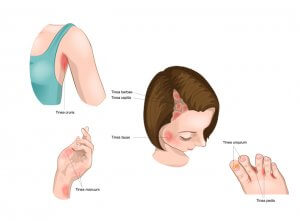 גזזת – trichophytosis