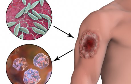 ליישמניאזיס של העור – cutaneous leishmaniasis