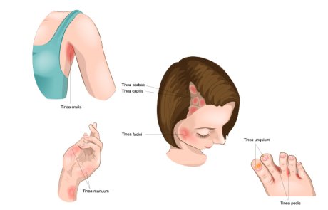 גזזת – trichophytosis